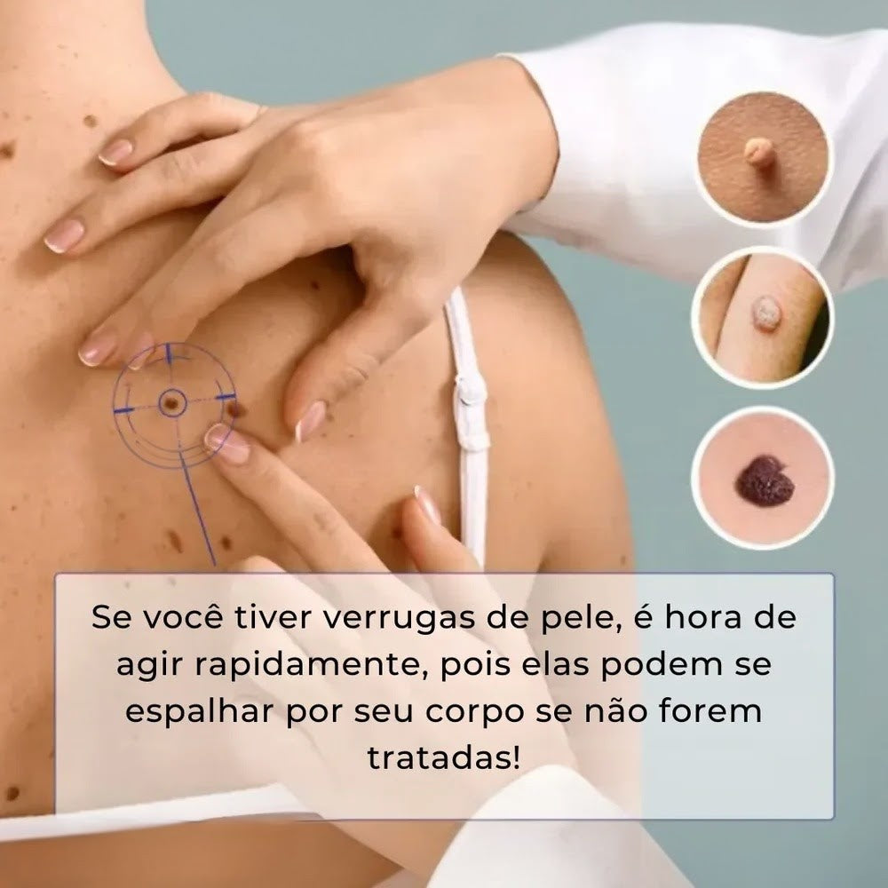 Caneta Removedora de Verrugas RemoVex™ (acrocordons)