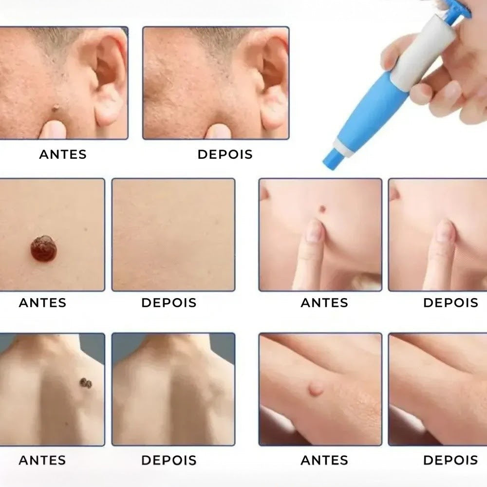 Caneta Removedora de Verrugas RemoVex™ (acrocordons)