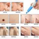Caneta Removedora de Verrugas RemoVex™ (acrocordons)