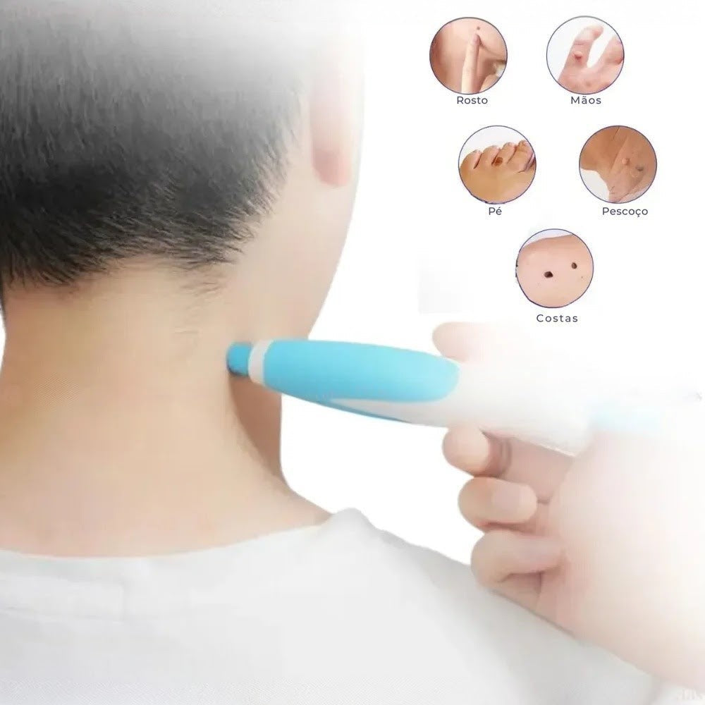 Caneta Removedora de Verrugas RemoVex™ (acrocordons)